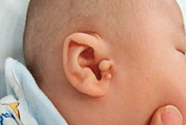 Preauricular Tags Removal Abu Dhabi